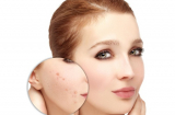 Sẹo lồi chẳng còn dù một vết nếu thực hiện các cách dưới đây