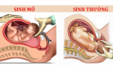Những mặt lợi - hại của sinh mổ so với sinh thường các mẹ nhất định phải biết