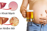 4 yếu tố gây bệnh gan hàng đầu