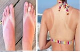 14 bí kíp làm giảm đau rát khi da bị cháy nắng