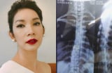 Bệnh siêu mẫu Xuân Lan mắc phải là lời cảnh báo cho tất cả các chị em khi đi giày cao gót