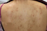 Những cách trị mụn lưng bằng nguyên liệu thiên nhiên hiệu quả nhất