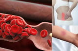 Những dấu hiệu đông máu cực kì nguy hiểm có thể đột quỵ bất cứ lúc nào