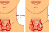 Những dấu hiệu phát hiện ung thư tuyến giáp sớm nhất, chị em không được bỏ qua