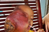 Cha mẹ thiếu hiểu biết, bé 6 tuổi mang khối u ác tính kinh khủng trên mặt vì đắp lá thuốc trôi nổi