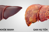 Những thực phẩm hàng ngày gây tổn thương gan nghiêm trọng thực phẩm đầu tiên rất nhiều người thích