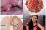 10 căn bệnh ung thư gây tử vong HÀNG ĐẦU thế giới, diễn viên Mai Phương có nằm trong TOP NGUY HIỂM này không?