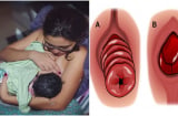 Báo hiệu chị em sau khi sinh hãy coi chừng nguy cơ mắc bệnh này rất cao