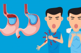 Tuyệt đối đừng coi thường ợ nóng nó có thể là dấu hiệu của nhiều căn bệnh tiềm ẩn
