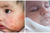 5 căn bệnh di truyền thường xuất hiện ở trẻ sơ sinh để lại nhiều hệ lụy về sau, bố mẹ cần chú ý