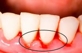 Chảy máu chân răng cảnh báo nhiều căn bệnh nguy hiểm không thể bỏ qua