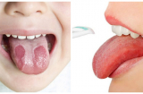 Điểm mặt 6 dấu hiệu bất thường ở vùng lưỡi cảnh báo vấn đề nguy hiểm về sức khỏe không thể bỏ qua