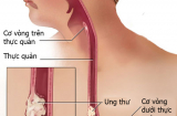 Thấy dấu hiệu này hãy tới bệnh viện khám ung thư thực quản ngay kẻo giai đoạn cuối thì cứu không kịp