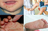 Bác sĩ cảnh báo điều phải biết về bệnh tay chân miệng, cấp độ nguy hiểm - cách chữa bệnh cho trẻ tại nhà