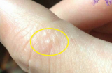Nếu bạn nhận thấy dấu hiệu này cần lập tức tới bệnh viện ngay kẻo cứu không kịp