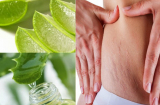 Mẹ bỉm sữa sau sinh nhớ bỏ túi ngay 'bí kíp' này XÓA TAN vết rạn da, bụng phẳng lì chỉ sau 1 tuần