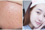 Làm theo cách này mụn ẩn hết sạch sẽ trong 7 ngày, trả lại Mừng SHBET phiên bản mới 2025 mịn màng không còn sần sùi, thô ráp