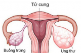 Hotgirl qua đời vì ung thư buồng trứng -  dấu hiệu báo bệnh rất chuẩn khi quan hệ tình dục