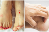 Nhìn thấy dấu hiệu này ở chân hãy đi khám ngay kẻo tới lúc cứu không kịp