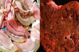 Thực phẩm khiến lá gan nhàu nát, thậm chí ung thư nhưng đang được rất nhiều người chuộng