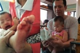 Bé gái 18 tháng tuổi bị bỏng bất thường ở chân khi đi học ở trường mầm non