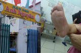 Bảo mẫu mở nhầm nước nóng, bé gái 18 tháng tuổi bỏng nặng và kinh nghiệm cha mẹ cần lưu tâm khi gửi trẻ