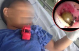 Ve chó làm tổ lúc nhúc trong tai bé trai, mẹ hoảng hồn khi biết nguyên nhân thực sự