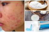 Nghe lời bác sĩ da liễu: Đang mụn nặng thì tránh xa ngay những thứ này càng nhanh càng tốt kẻo mãi không khỏi
