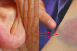 Nếu thấy dấu hiệu này, bạn đang mắc 1 bệnh ung thư vô cùng nguy hiểm đấy – Hãy đi khám ngay