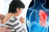 4 dấu hiệu ung thư phổi sớm nhất, đi khám ngay để tự cứu lấy mình