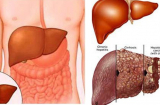Vạch mặt thực phẩm quen thuộc khiến lá gan nhàu nát, đối mặt với ung thư quá nhiều người chuộng