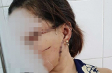 Cuồng ghen, chồng 'hờ' cắt gân chân, rạch mặt vợ dã man