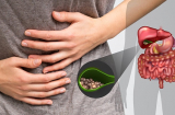 Chỉ mặt 3 kiểu ăn uống dễ hình thành sỏi mật: Người Việt mắc cả 3, nên biết sớm để thay đổi