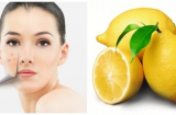5 cách trị sẹo nhanh và hiệu quả như chưa hề có sẹo