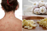 Mụn trứng cá nhiều cỡ nào cũng bị đánh bay với vài củ tỏi nhuyễn nếu làm đúng cách