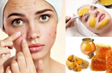 Mặt chi chít mụn cũng sẽ bị đánh bay sạch sẽ sau 1 tuần nhờ áp dụng 5 bí kíp này