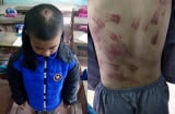 Bất ngờ với lời kể của cháu bé bị sư thầy đánh bầm tím khắp người
