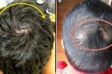 Thực hư câu nói ‘Một xoáy sống lâu, hai xoáy trọc đầu, ba xoáy chết yểu, 4 xoáy làm quan’?