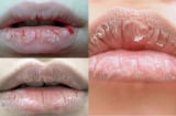 Thủ phạm khiến môi khô, nứt nẻ, bong tróc quanh năm suốt tháng