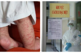 Trẻ em và bà bầu cần hết sức thận trọng vì dịch sởi đang bùng phát, tăng hơn 50 lần cùng kỳ