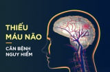 Dấu hiệu điển hình của bệnh thiếu máu não: Hãy cảnh giác sớm để tránh tử thần gõ cửa bất ngờ