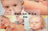 Chính vì điều này khiến con bạn bị bệnh sởi, muốn phòng cha mẹ nhất định phải tránh