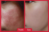 Bao công sức 'đổ ra biển hết' nếu làm sạch lỗ chân lông mà bỏ qua bước này