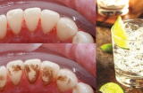 Loại nước chỉ cần ngậm vào là cao răng biến mất sau 1 đêm giúp bạn tự tin tỏa sáng nụ cười ngày 8/3