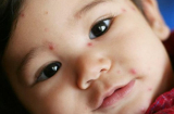 Thủy đậu đang vào mùa dịch: Không chăm sóc đúng cách sẽ để lại nhiều di chứng, thậm chí nguy hiểm tính mạng