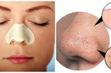 Lộ diện bí kíp lột mụn đầu đen đúng cách đồng thời giúp se khít lỗ chân lông