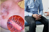 Nghĩ cơn đau vùng hậu môn là bệnh trĩ: Bệnh nhân nhiễm vi khuẩn ăn thịt người, thối ruột mà không hay