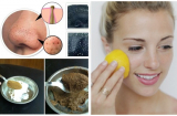 Mụn đầu đen, đầu trắng li ti nhiều đến mấy cũng hết nhờ chà thứ này lên da