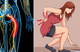 Bài thuốc từ sữa tươi và tỏi giúp người đau thần kinh tọa lấy lại sức khỏe không tốn 1 viên thuốc