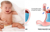 Con thường xuyên nôn trớ, mẹ dùng TUYỆT CHIÊU tránh cho con khỏi nhiều biến chứng nguy hiểm